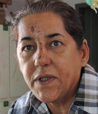 Mulher sofre queda em declive e fratura nariz 