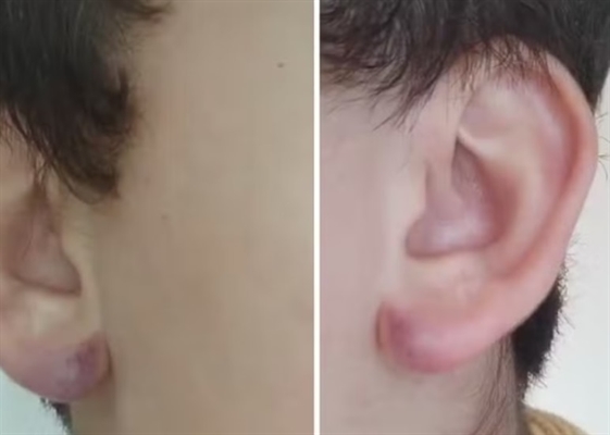  A mãe afirma que, ao buscar o filho, percebeu que as orelhas da criança estavam roxas e lesionadas (Foto: Reprodução)