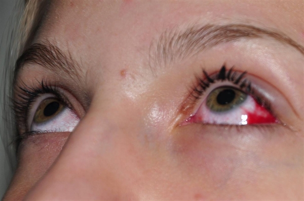 Doença viral altamente contagiosa se espalha com rapidez e exige cuidados para conter novas transmissões em Votuporanga (Foto: Prefeitura de Votuporanga)