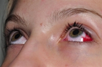 Casos de conjuntivite disparam e surto já atinge quase 2 mil pessoas em Votuporanga