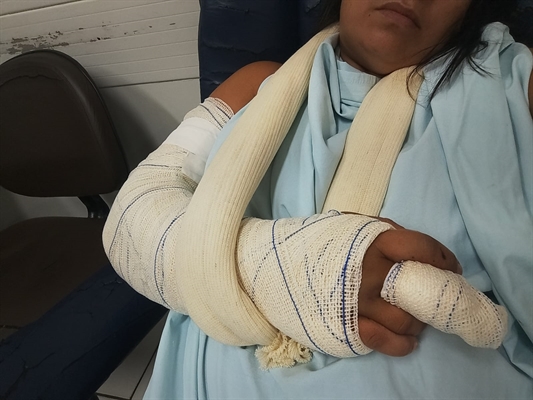 Colisão provocada por carrinho de recicláveis resultou em fraturas graves e perda total de motocicleta utilizada para o trabalho. Foto: Arquivo pessoal