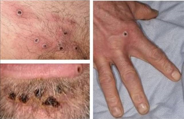 Quatro homens da região já testaram positivo para a varíola dos macacos, doença que tem preocupado o mundo inteiro (Foto: Reprodução)