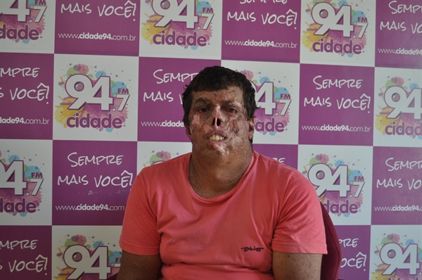 Ronaldo Santana Santos é portador de xeroderma pigmentosum, uma doença rara e que provoca feridas na pele (Foto: A Cidade)