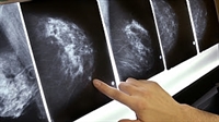 A mamografia identifica o câncer quando ainda não é palpável em um exame clínico ou através do autoexame realizado pela paciente (Foto: Divulgação)