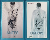 Manchas pretas no exame são tumores. O primeiro foi realizado há um mês, quando o paciente chegou ao hospital. Nesta semana, o resultado do exame mostra que a maioria das manchas desapareceu, e as que restam sinalizam a evolução da terapia. — Foto: Reprodução/Fantástico